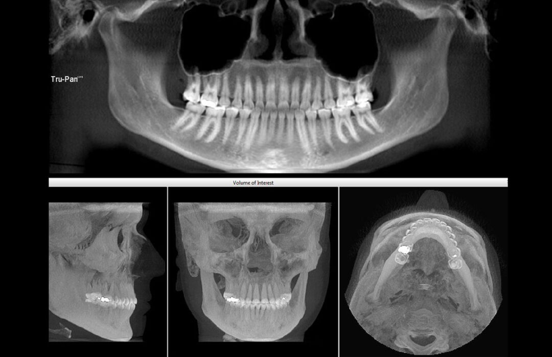 Cbct Scans And Lab Services Dr Eskow Prosthodontics